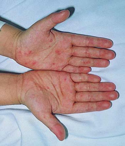 Bệnh tay chân miệng và cách phòng ngừa