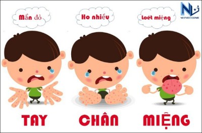 Phòng ngừa và xử lý bệnh Tay, chân,miệng